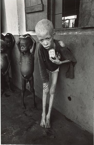 An Albino Boy Begs in Biafra - Don McCullin 1970